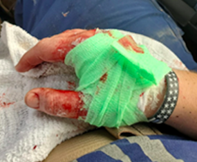 Cuts and Lacerations