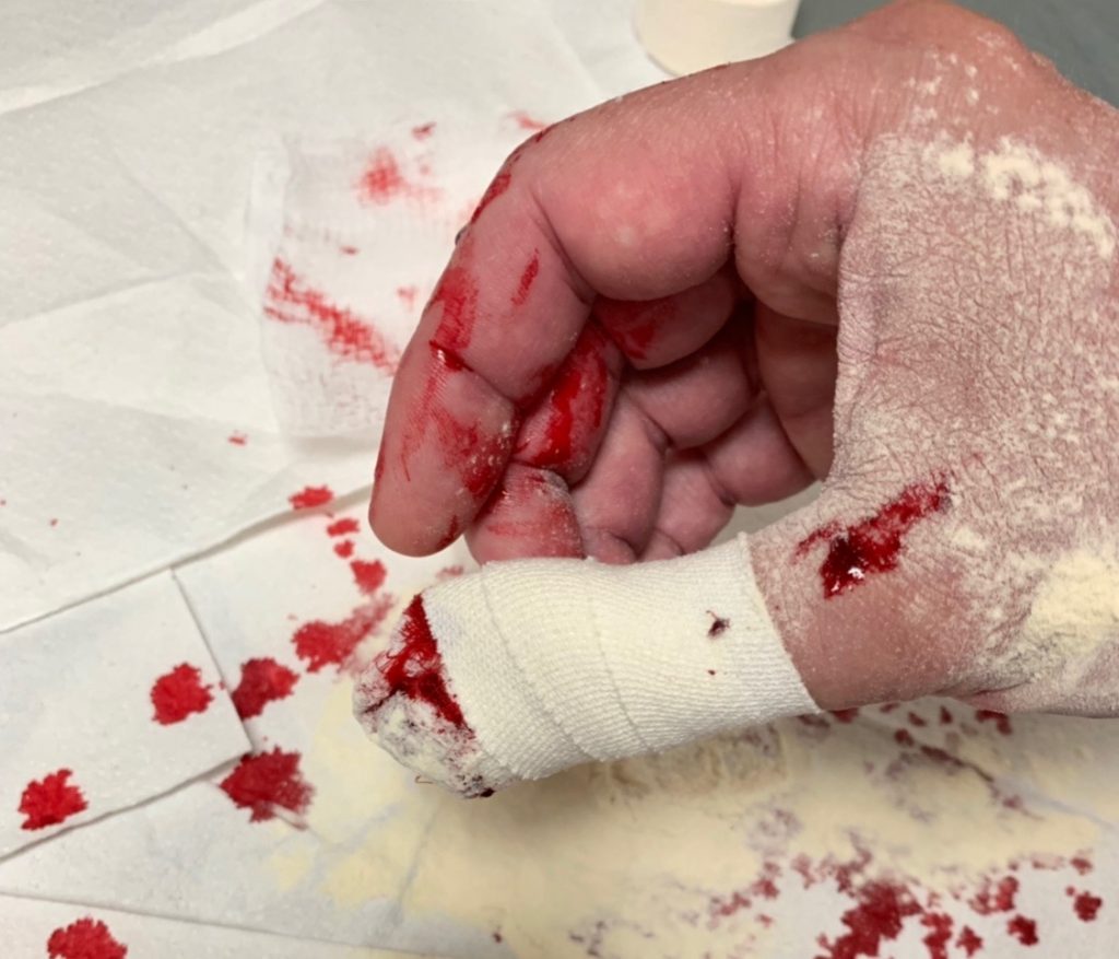 Blood Thinner Patients