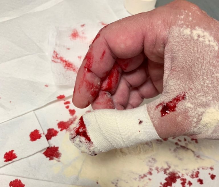 Blood Thinner Patients