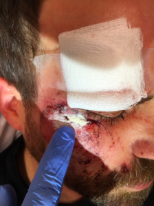 BleedStop Motorcycle Accident