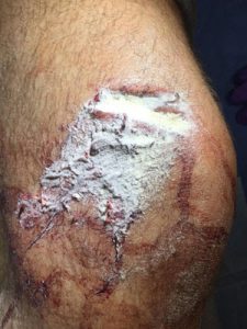 BleedStop Testimonials 6